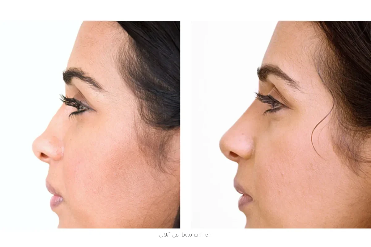 فیلر بینی و نکات ایمنی آن